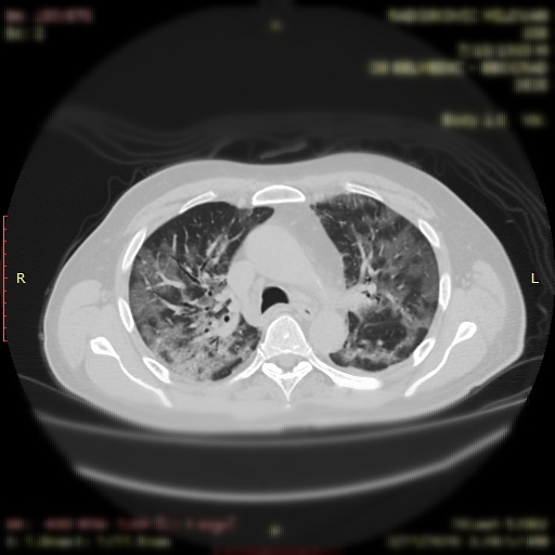 snimak pluća pacijenta koji ima Covid19