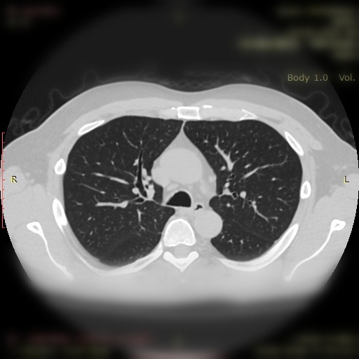 snimak pluća zdravog pacijenta 